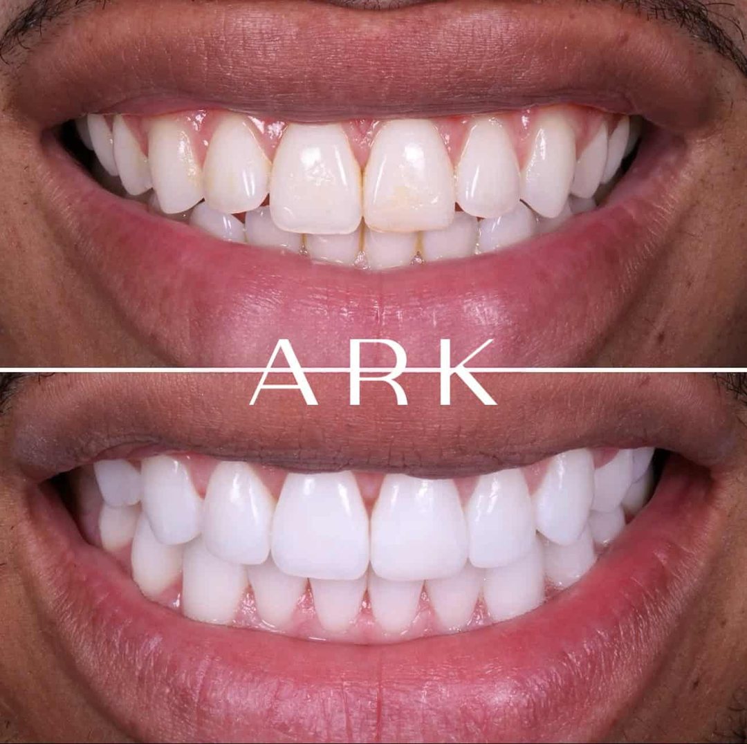 Composite bonding before and after – Ark Dentistry patient (before above, after below)