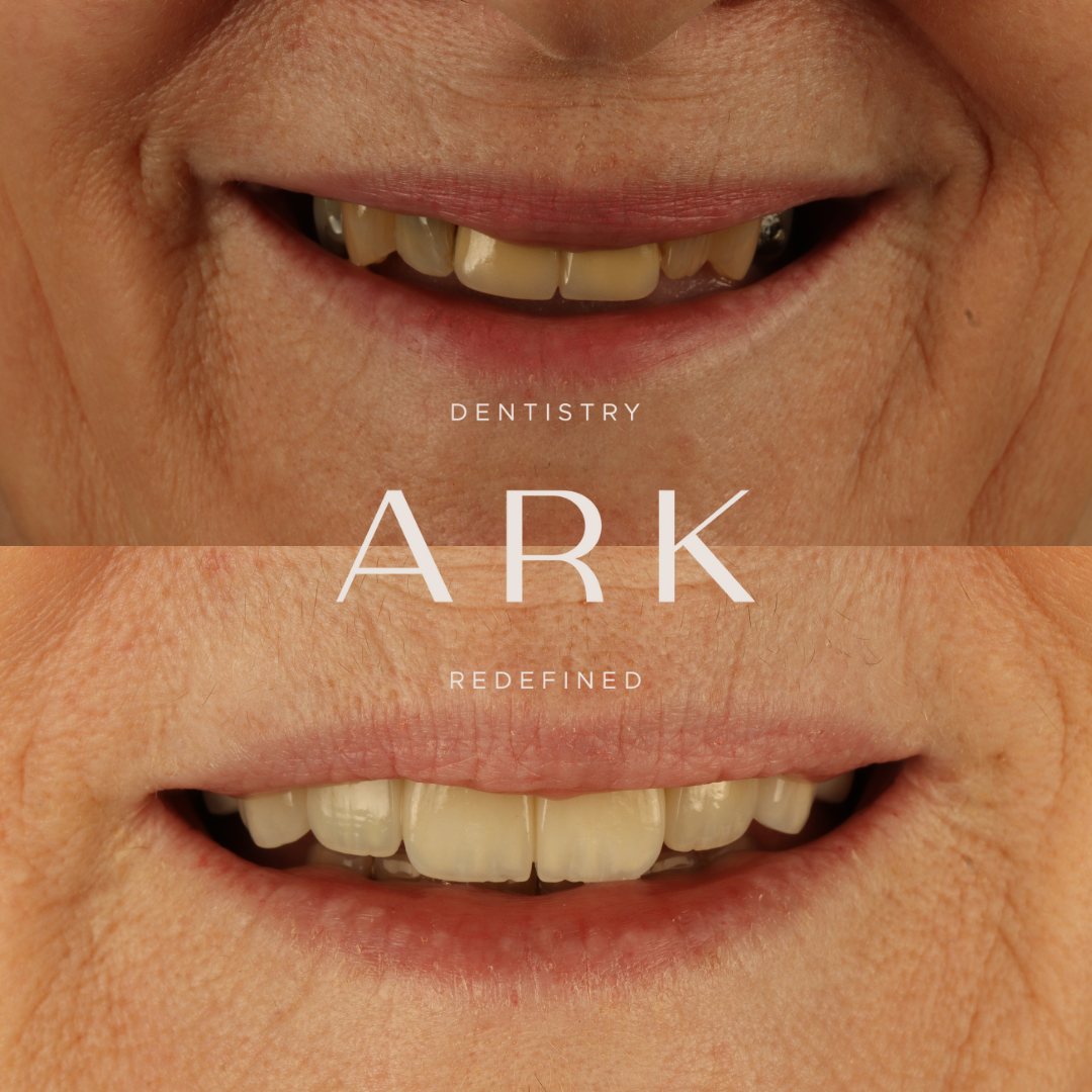 Veneers before and after – Ark Dentistry patient (before above, after below)