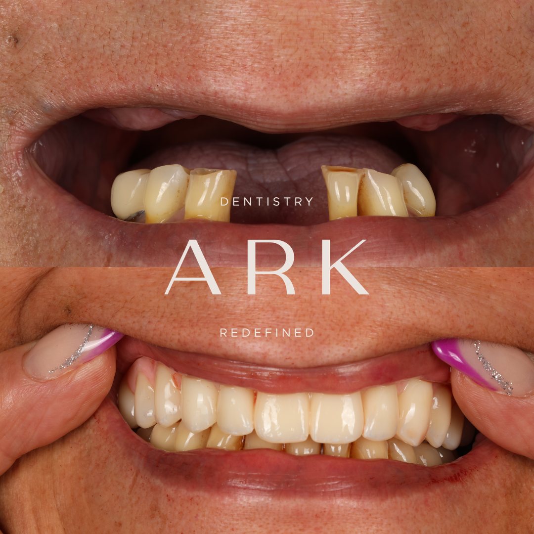 Dental implants before and after – Ark Dentistry patient (before above, after below)