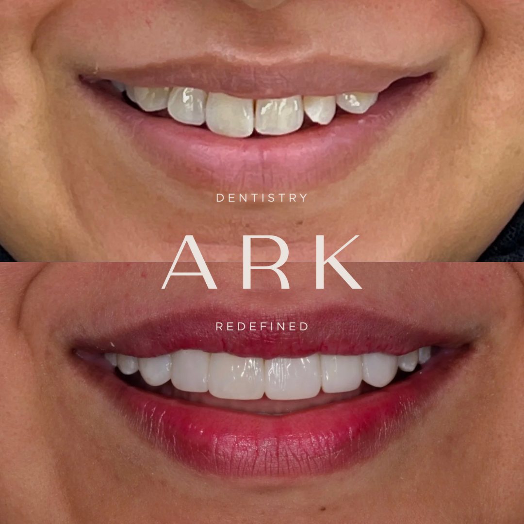 Clear aligners before and after – Ark Dentistry patient (before above, after below)