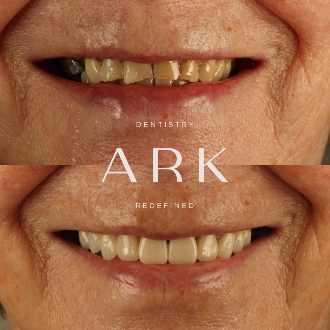 Veneers before and after – Ark Dentistry patient (before above, after below)