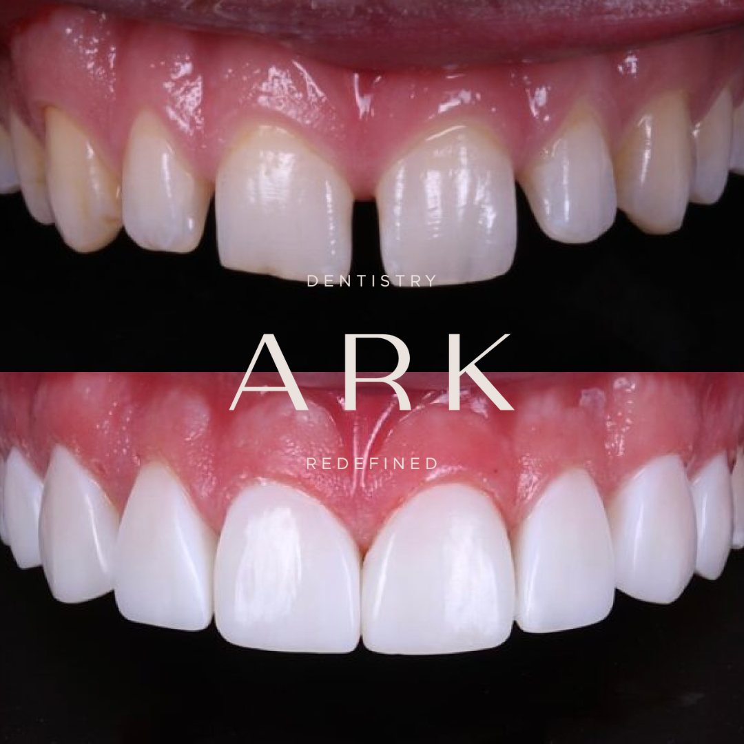 Clear aligners before and after – Ark Dentistry patient (before above, after below)