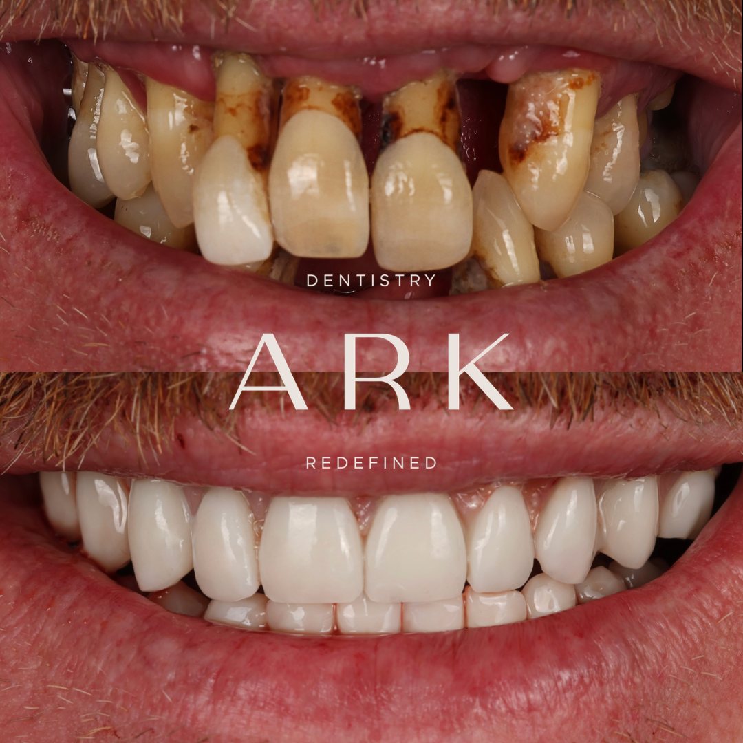 Dental implants before and after – Ark Dentistry patient (before above, after below)