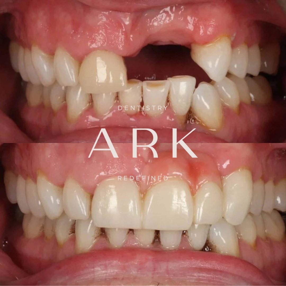 Dental implants before and after – Ark Dentistry patient (before above, after below)