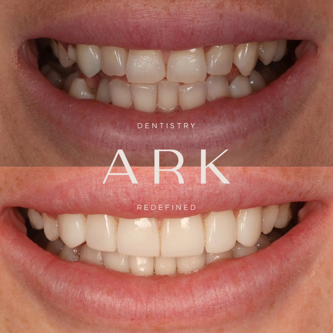 Clear aligners before and after – Ark Dentistry patient (before above, after below)