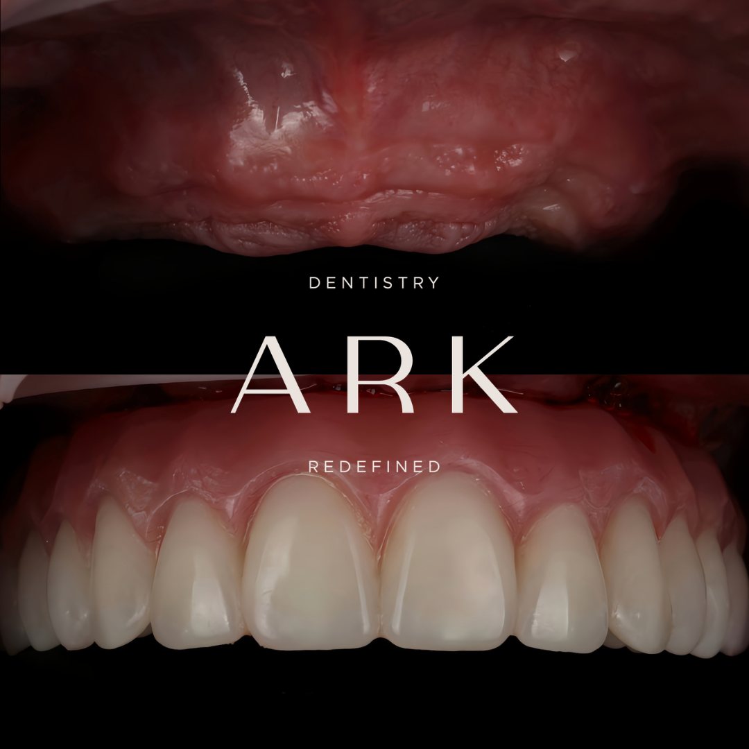 Dental implants before and after – Ark Dentistry patient (before above, after below)