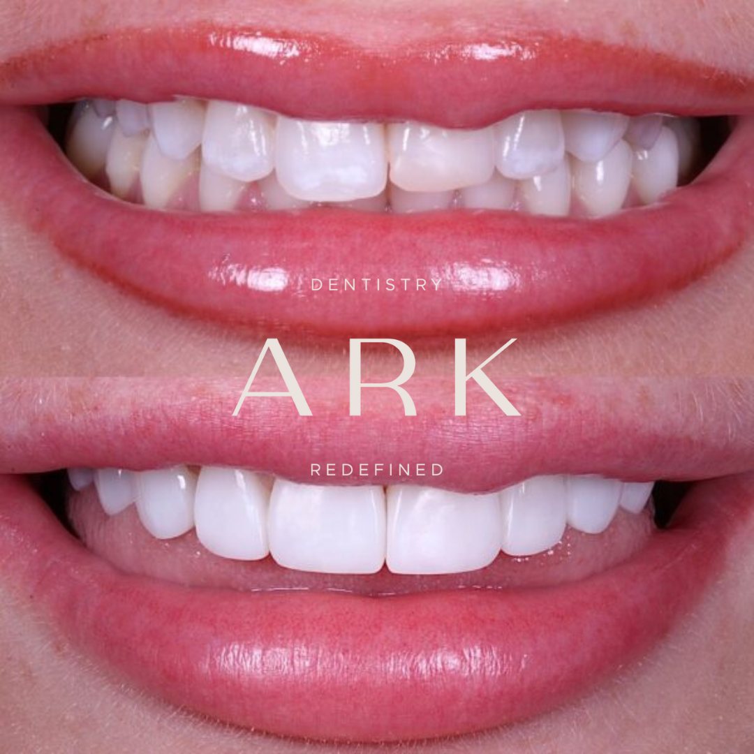 Composite bonding before and after – Ark Dentistry patient (before above, after below)