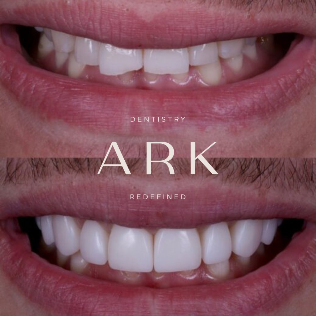 Second composite bonding before and after – Ark Dentistry patient