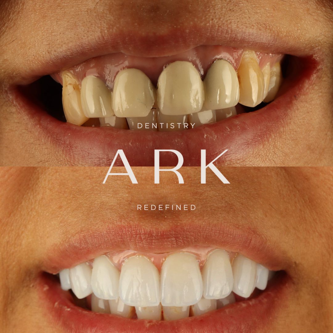 Veneers before and after – Ark Dentistry patient (before above, after below)