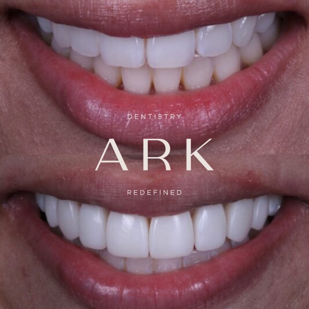 Composite bonding before and after – Ark Dentistry patient (before above, after below)