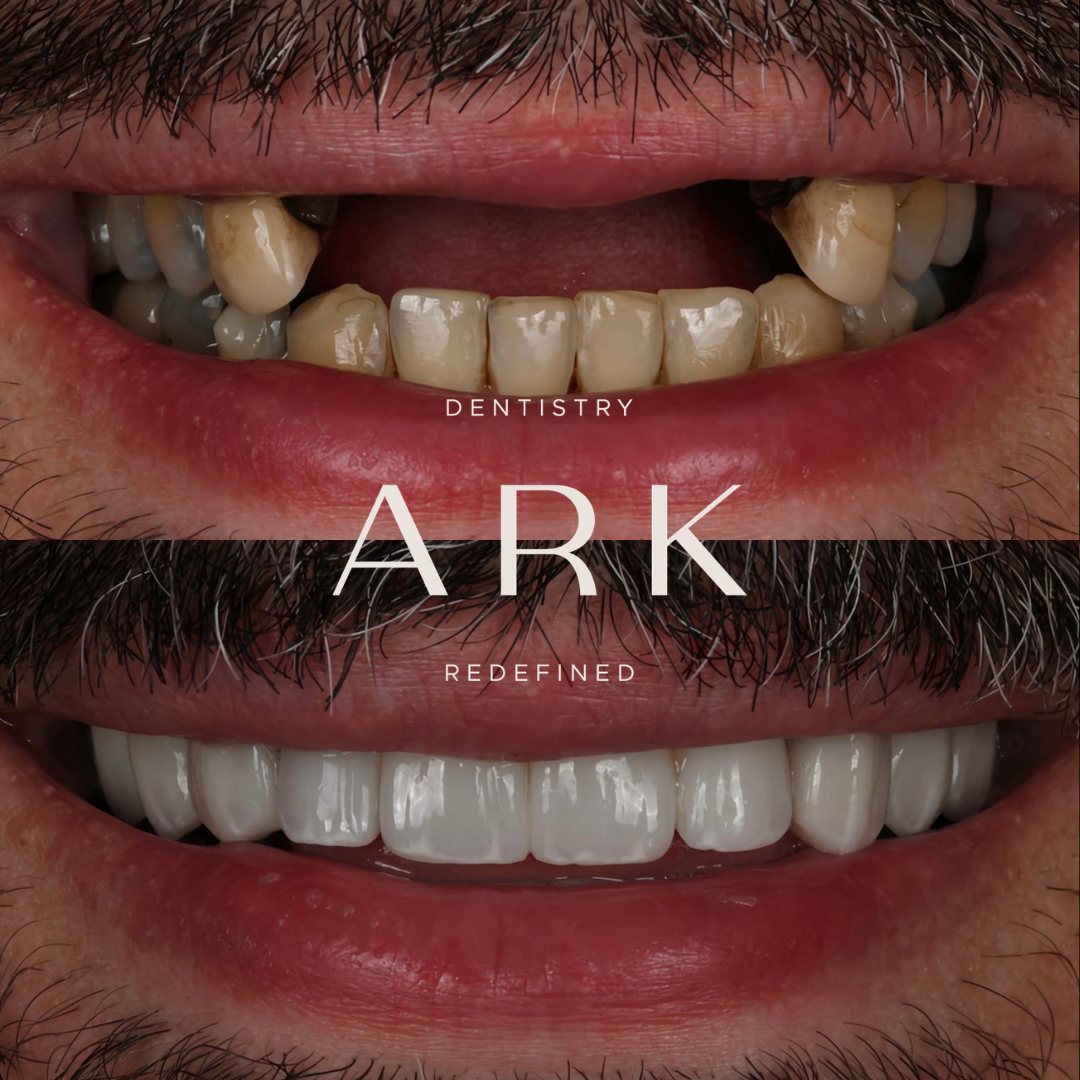 Dental implants before and after – Ark Dentistry patient (before above, after below)