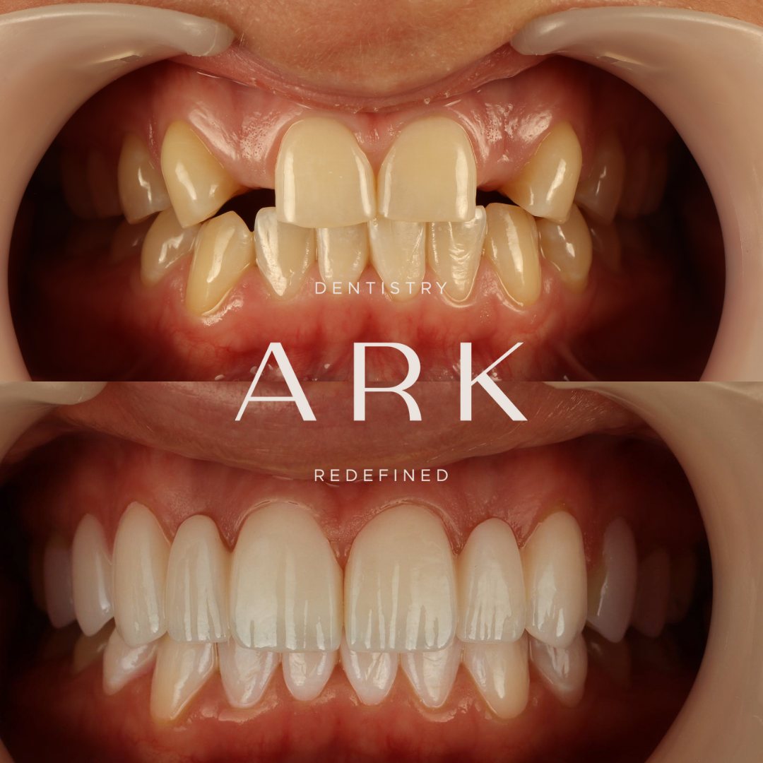 Veneers before and after – Ark Dentistry patient (before above, after below)